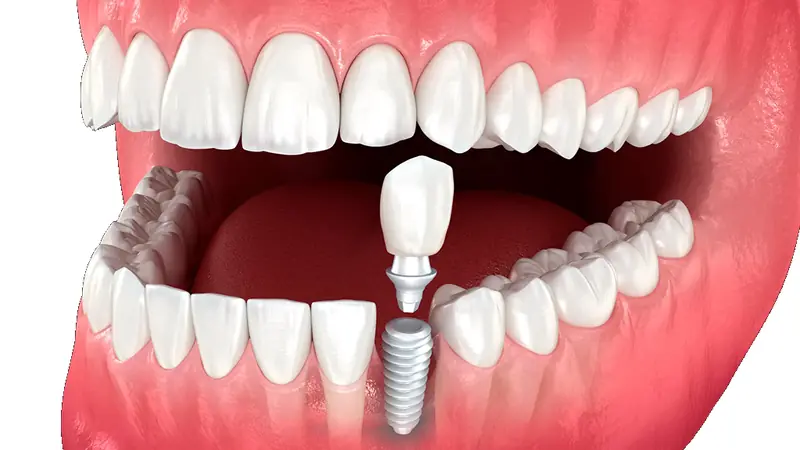 Illustrazione di un impianto dentale con corona